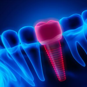 Dental,Implantat,-,Implant,-,3d,Illustration