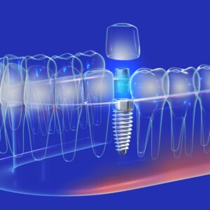 3d,Illustration,Of,A,Dental,Implant,In,A,Transparent,Glass