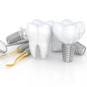 Dental,Implant,Set,Design.,3d,Illustration