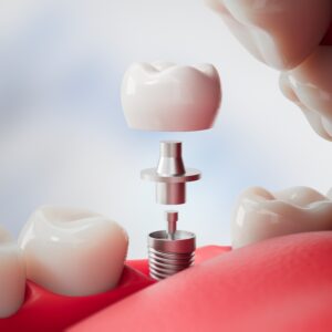 Dental,Implant,Parts,Including,Crown,,Abutment,,And,Screw,Inside,Open