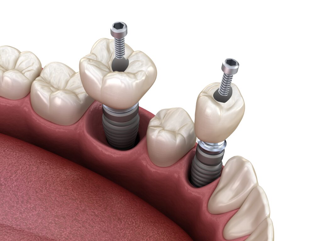 365디지털치과-대전네비게이션임플란트-소구치 및 어금니 치아 크라운을 임플란트 위에 장착하고 나사로 고정
