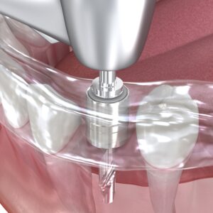 365디지털치과-대전네비게이션임플란트-이식 절차를 위한 수술 가이드