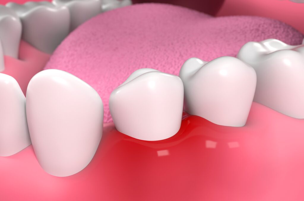 365디지털치과-대전네비게이션임플란트-잇몸 염증 (치은염)