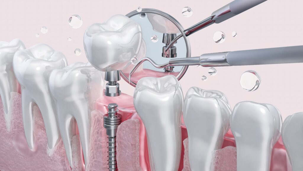 365디지털치과-대전네비게이션임플란트-치아 임플란트. 결손된 치아를 대체하기 위해 턱뼈에 티타늄 임플란트를 식립하는 시술