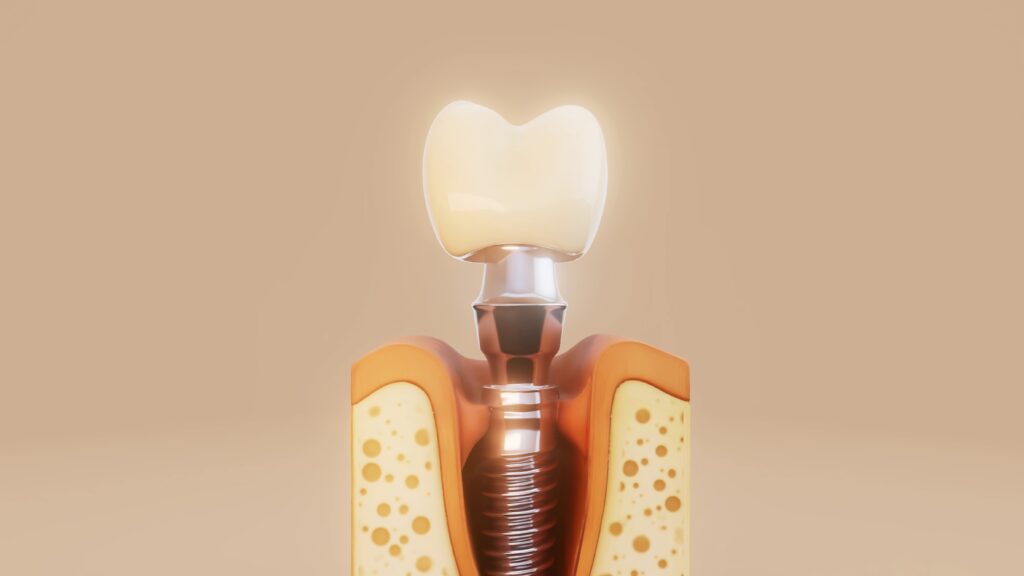 365디지털치과-대전네비게이션임플란트-턱뼈-내부의-치아-임플란트의-개념적-3D-예시