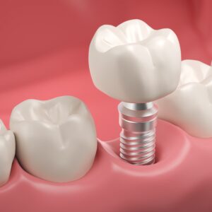 365디지털치과-둔산동네비게이션임플란트-악 반쪽 모형 내부에 식립된 치과 임플란트