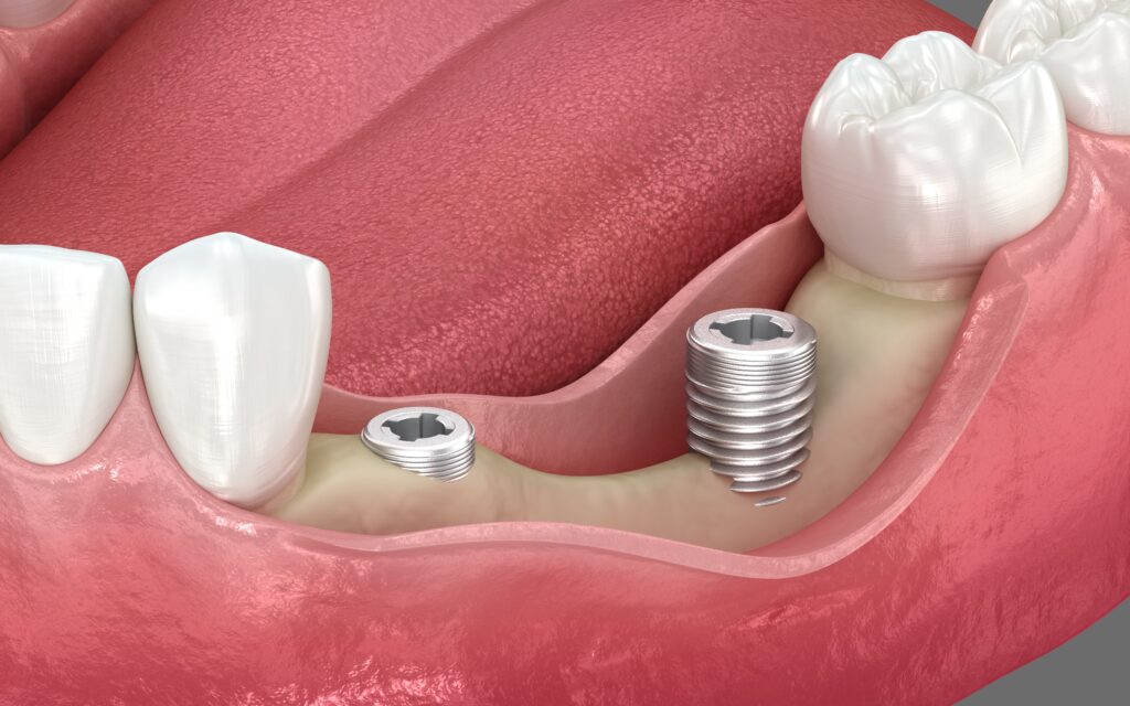 365디지털치과-둔산동네비게이션임플란트-치과 임플란트와 뼈가 손실