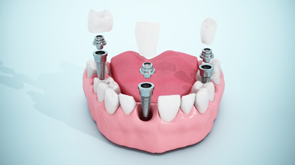 365디지털치과-둔산동네비게이션임플란트-하악-반쪽-모형-내부에-식립된-치과-임플란트