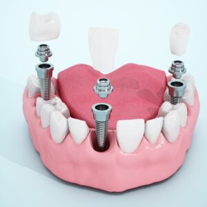 365디지털치과-둔산동네비게이션임플란트-하악-반쪽-모형-내부에-식립된-치과-임플란트