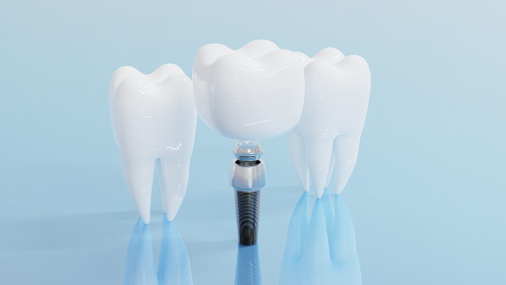 [대전임플란트] 임플란트: 임플란트 수술 개념 이미지