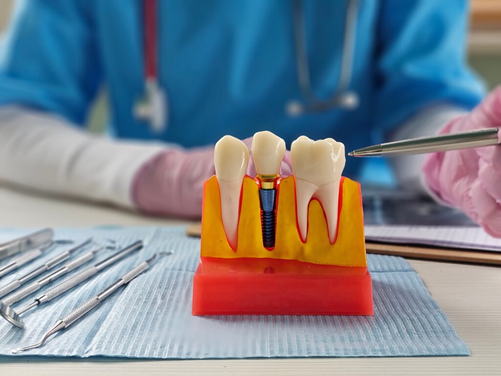 [대전임플란트] 임플란트: 임플란트 설명을 위해 치과 도구를 사용한 치과 모델