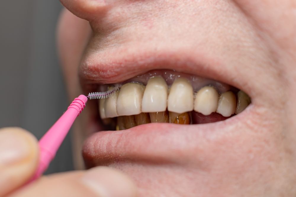 둔산동네비게이션임플란트-365디지털치과-치간칫솔로 관리하는 모습