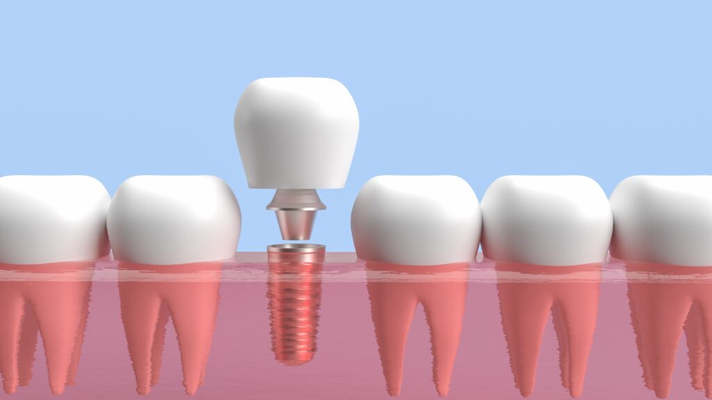365디지털치과-둔산동네비게이션임플란트-
치과 임플란트는 전형적으로 티타늄 또는 티타늄 합금과 같은 생체적합성 재료로 제조
