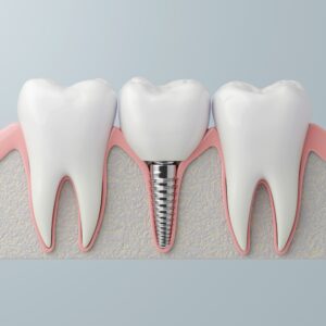 365디지털치과-둔산동네비게이션임플란트-단일 치과 임플란트 티타늄 소재