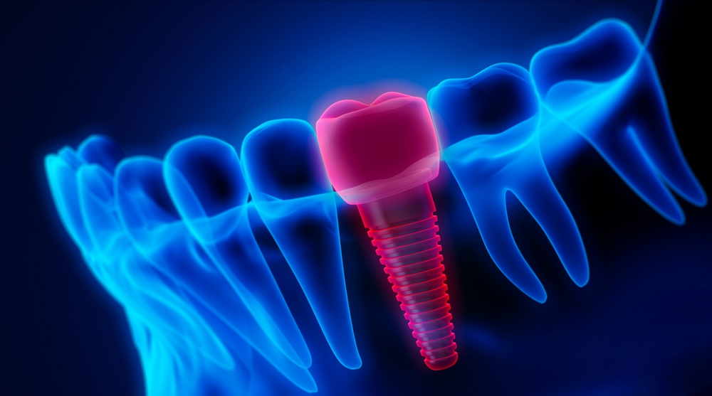 365디지털치과-둔산동네비게이션치과- 식립된 임플란트의 디지털적인 이미지