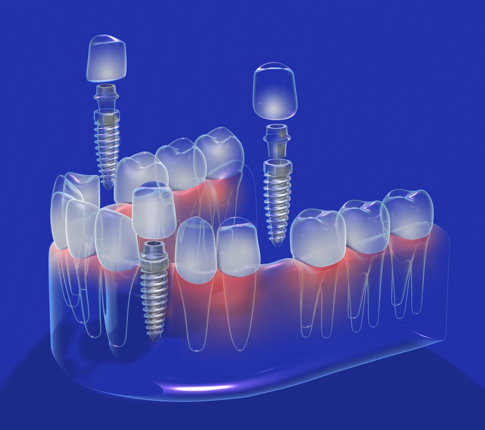 365디지털치과-둔산동네비게이션치과- 디지털 임플란트 이미지