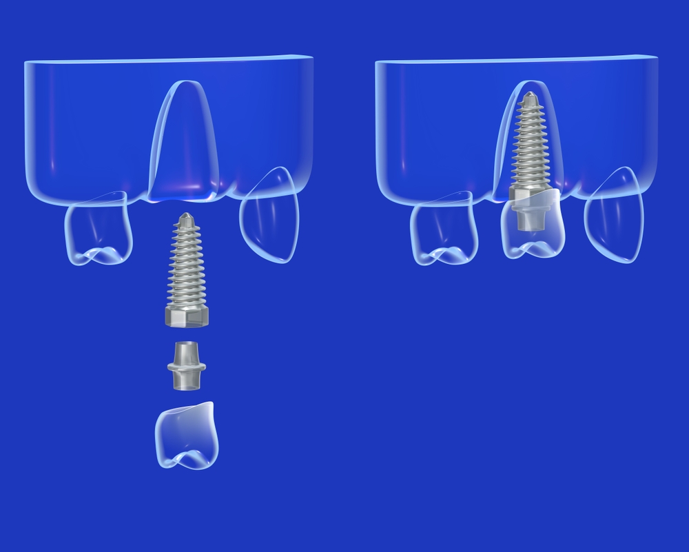 둔산동네비게이션임플란트-365디지털치과-디지털 임플란트를 보여주는 이미지