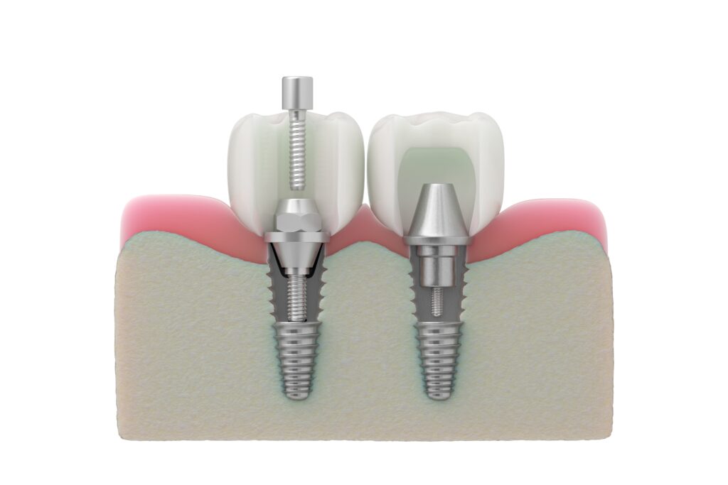 365디지털치과-둔산동네비게이션임플란트-임플란트 설명 이미지