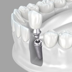 365디지털치과-둔산동네비게이션치과-임플란트 식립을 보여주는 이미지