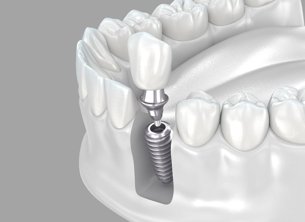 365디지털치과-둔산동네비게이션치과-임플란트 식립을 보여주는 이미지