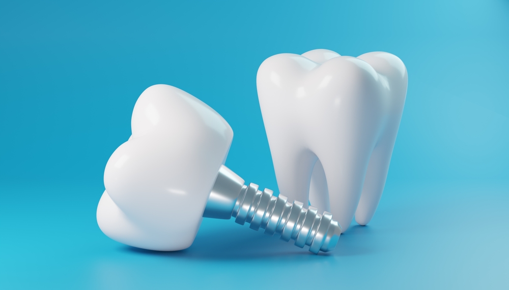 365디지털치과-둔산동네비게이션치과-파란색 배경에 치과 임플란트 및 자연 치아 모델