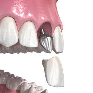 둔산동네비게이션임플란트