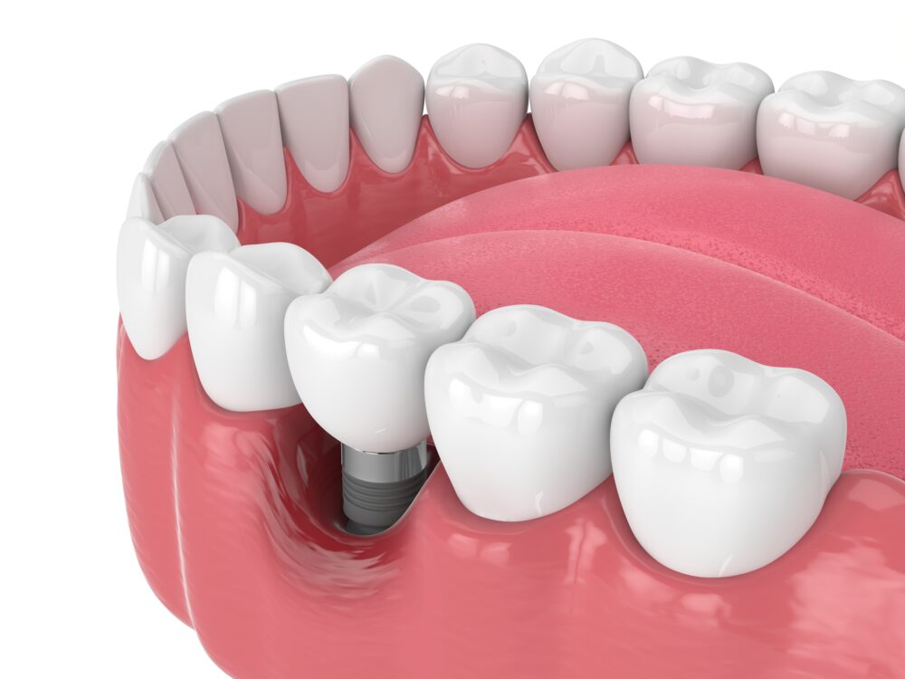 둔산동임플란트-365디지털치과-임플란트 주위염이 진행된 모습