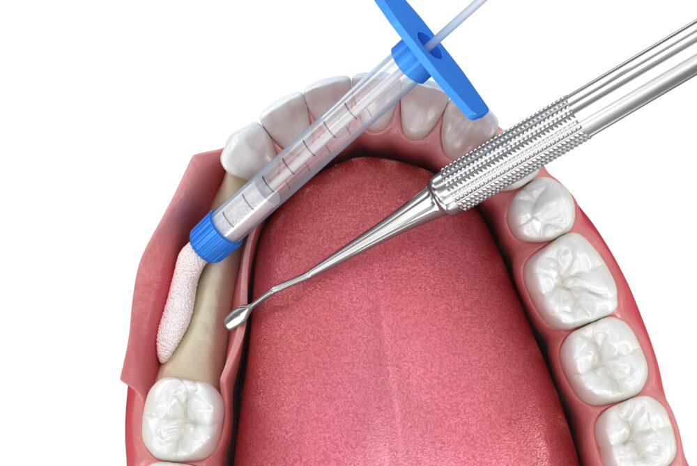 둔산동네비게이션임플란트-365디지털치과-임플란트 진행 전 뼈부족으로 이식중인 일러스트