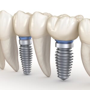 둔산동네비게이션임플란트