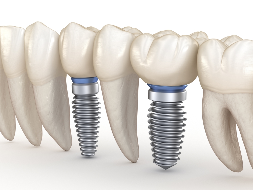 둔산동네비게이션임플란트