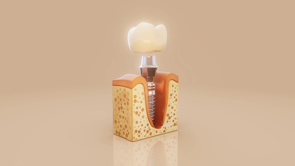 둔산동네비게이션임플란트-365디지털치과-임플란트 이미지