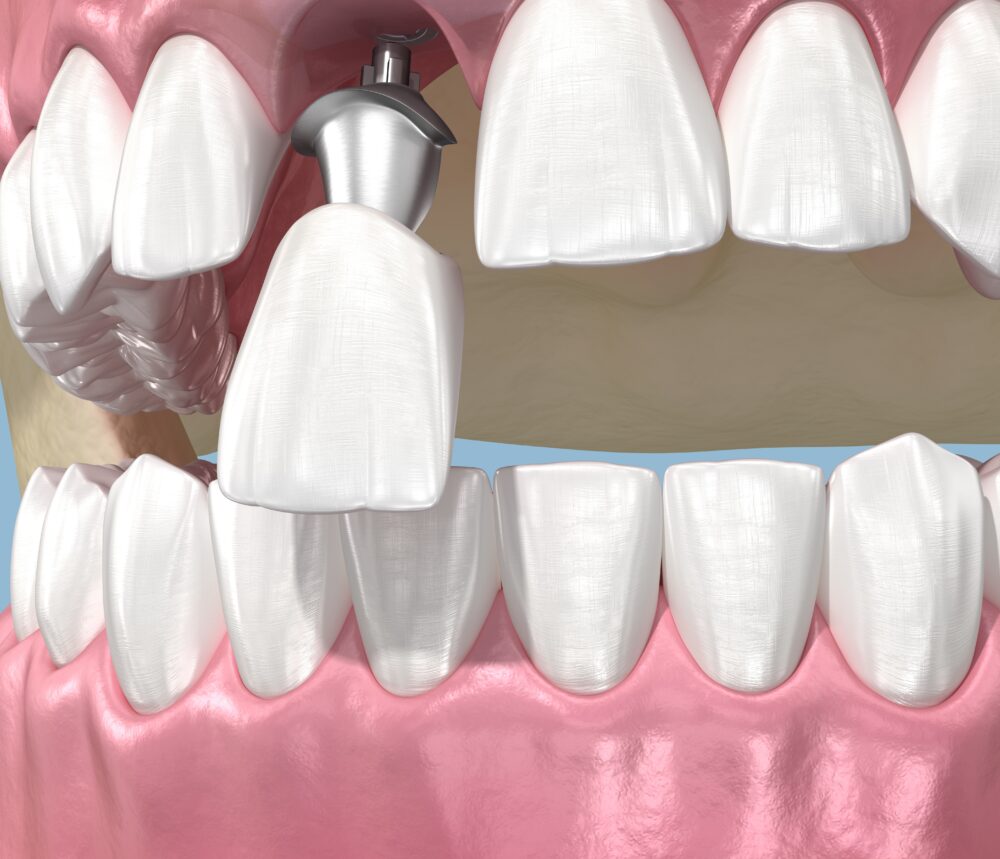 둔산동임플란트-365디지털치과-임플란트 재식립 하는 이미지