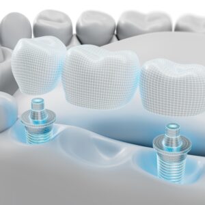 둔산동임플란트-365디지털치과-디지털임플란트이미지