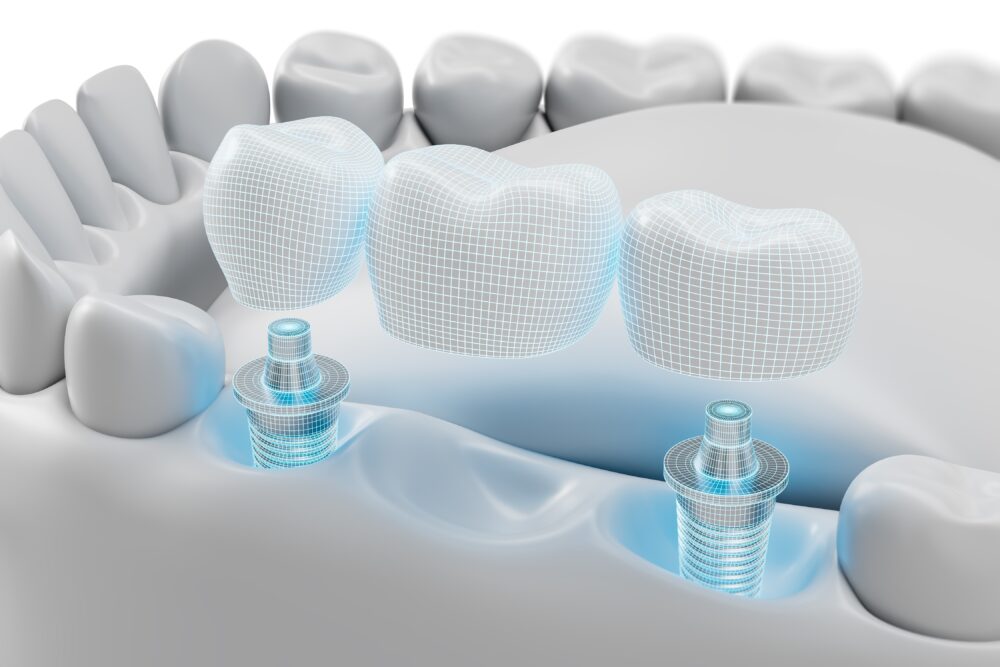 둔산동임플란트-365디지털치과-디지털임플란트이미지